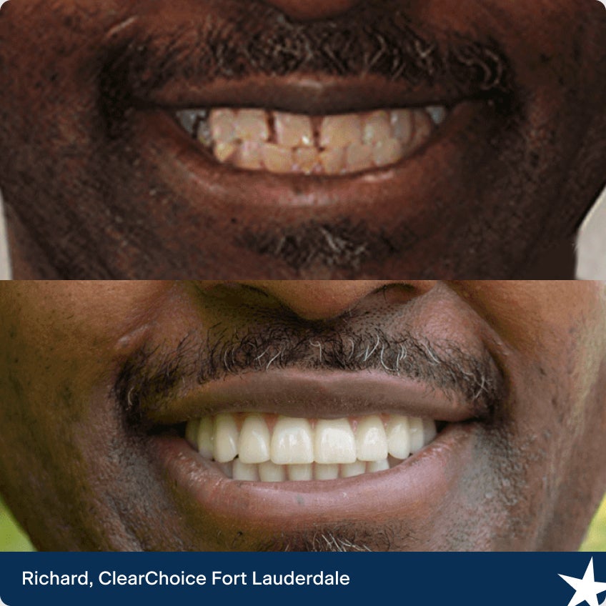 The before and after dental implant images of Richard. Our ClearChoice patient from Fort Lauderdale.
