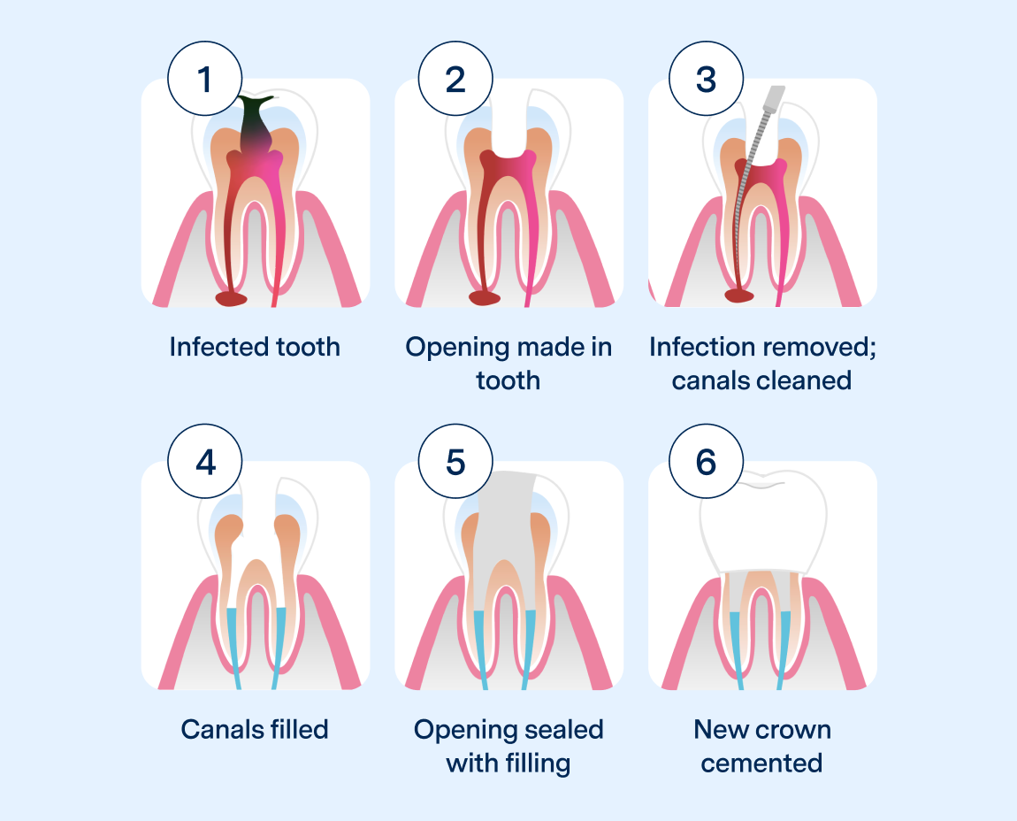 Six-step graphic of a root canal: Infection, access, cleaning, filling canals, sealing, and crown.