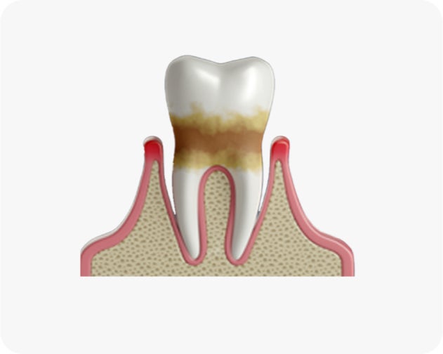  Illustration of a tooth with visible tartar build-up at the gum line and slight gum recession, highlighting the internal structure of the tooth and surrounding jawbone as it relates to periodontal disease.