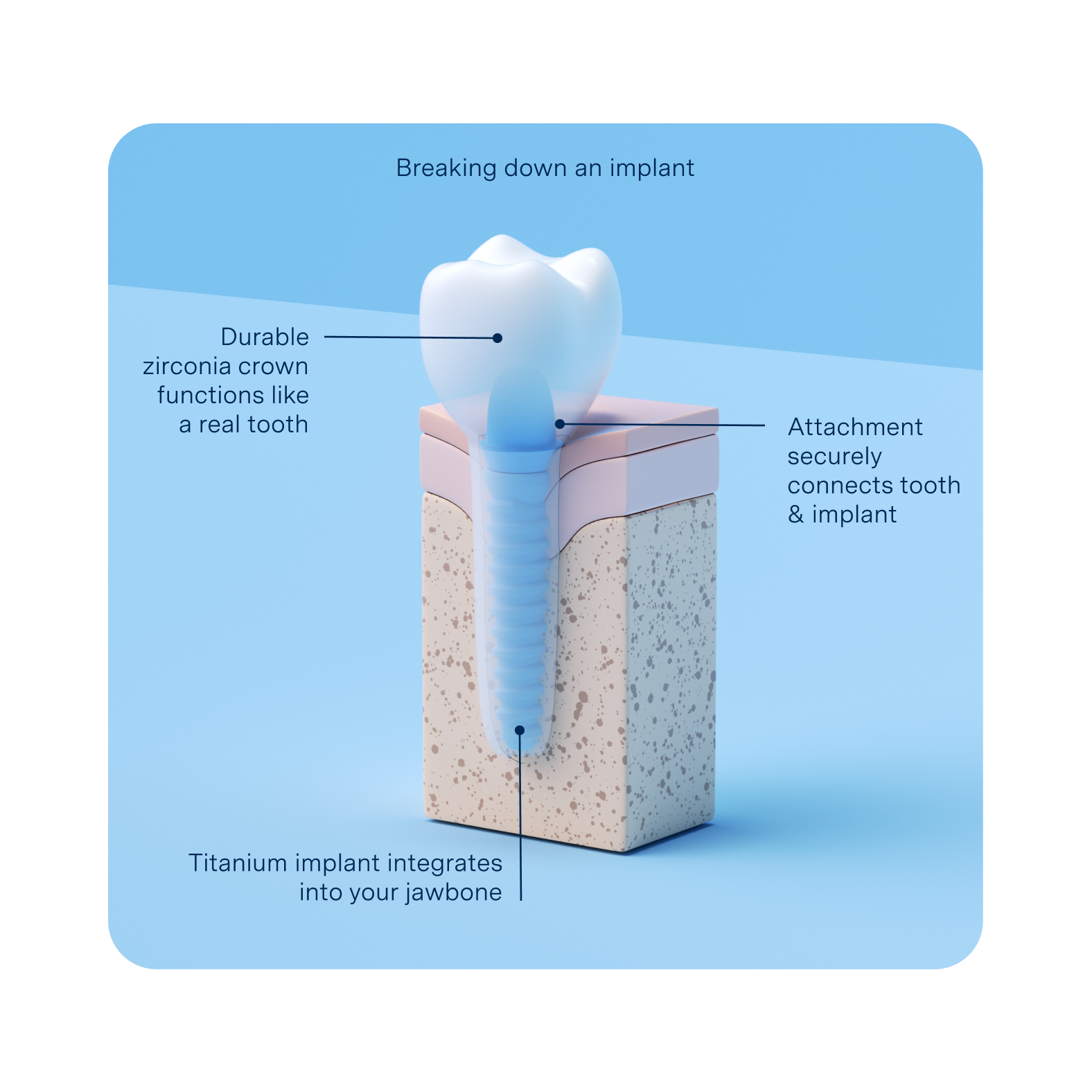 A 3D diagram showing the parts of a dental implant, including a durable zirconia crown, an attachment that securely connects the crown to the implant, and a titanium implant integrated into the jawbone.