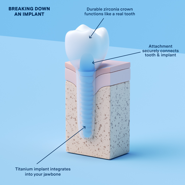 What are Dental Implants?