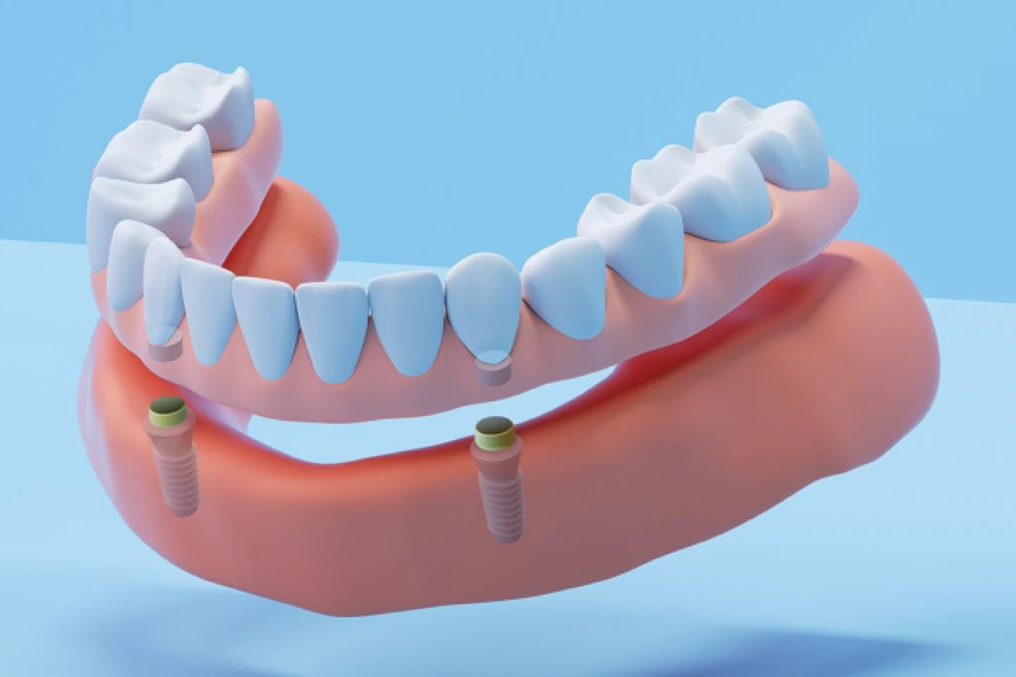 Aspen Dental snap-in dentures. 