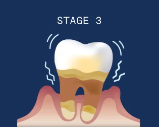 Receding gums stage 3 - Severe periodontitis: severe gum recession. Substantial bone loss and leads to tooth loss.
