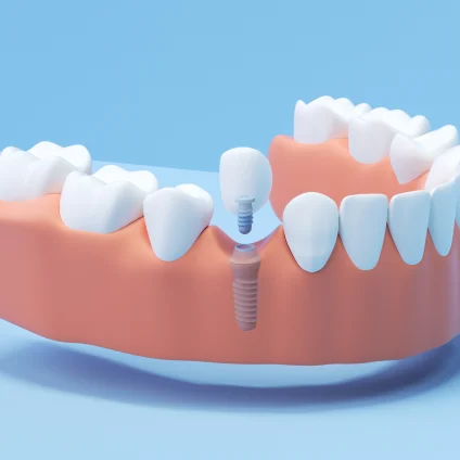A 3D render of Aspen Dental implant dentures. 