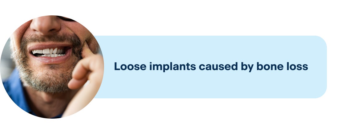 An image showing one of the common symptoms of an infected implant, including looseness of the implant.