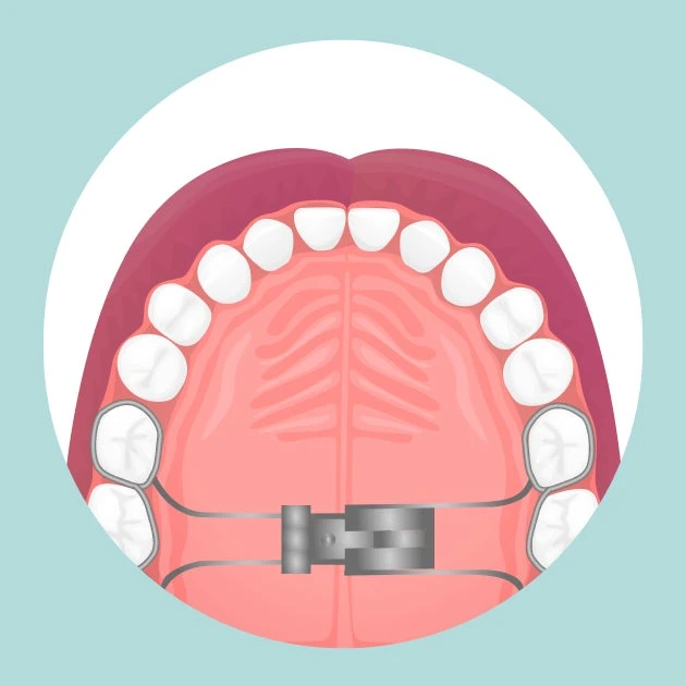 An illustration of a mouth with a palate expander on the teeth.