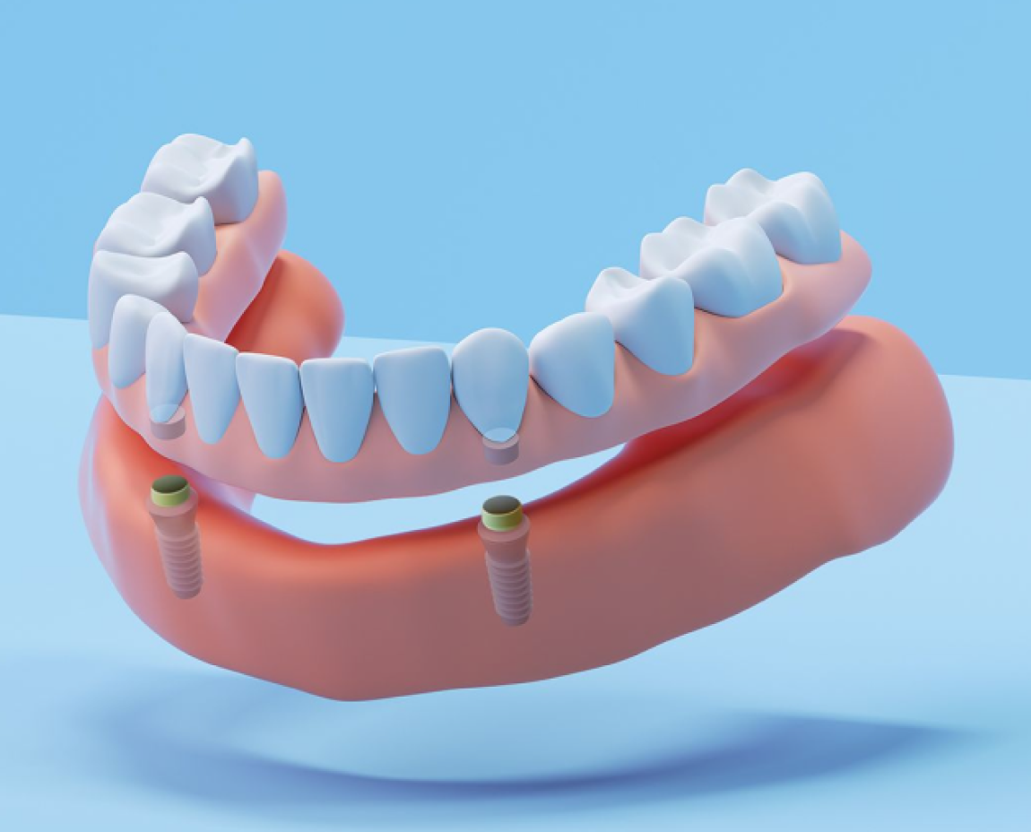 An illustration of removable dentures with implants. These are premium removable dentures with the secure fit of permanent titanium implants, designed for a comfortable, stable fit with no adhesives.