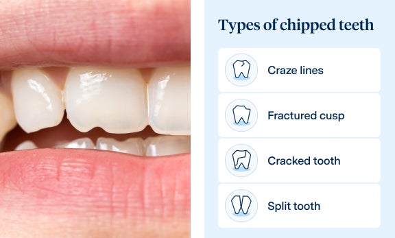 Illustration showing different types of chipped teeth, including craze lines, fractured cusp, cracked tooth, and split tooth. The image features simple icons representing each type, providing a visual guide for dental conditions.