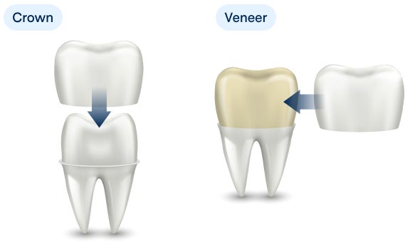 Diagram comparing dental crown and veneer. The crown covers the entire tooth, while the veneer covers only the front surface.