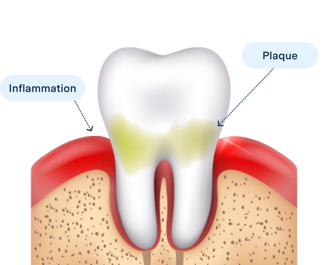 Illustration showing gingivitis with inflamed gums and plaque buildup on a tooth, highlighting early-stage gum disease for Aspen Dental.