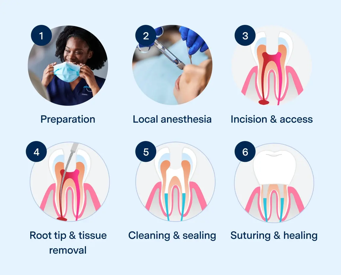 Illustrated step-by-step guide to a root canal procedure by Aspen Dental, featuring preparation, local anesthesia, incision and access, root tip and tissue removal, cleaning and sealing, and suturing and healing, with visual icons and descriptions.