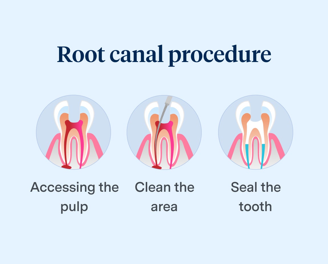 Diagram illustrating the three steps of a root canal procedure: accessing the pulp, cleaning the area, and sealing the tooth, highlighting professional dental care at Aspen Dental.