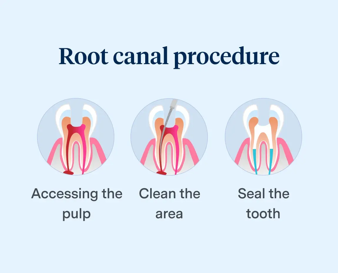 Diagram illustrating the three steps of a root canal procedure: accessing the pulp, cleaning the area, and sealing the tooth, highlighting professional dental care at Aspen Dental.