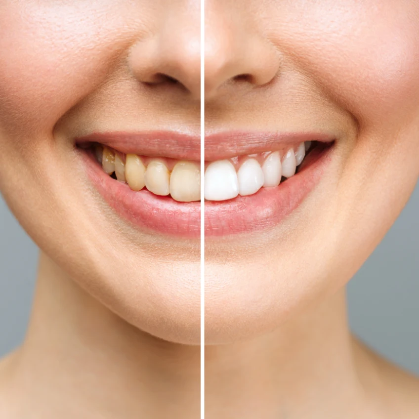 Before and after of a closeup of a woman smiling showing teeth whitening comparison.