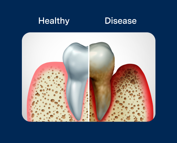 A healthy tooth and a diseased tooth side by side, showcasing the contrast between good oral hygiene and dental issues.