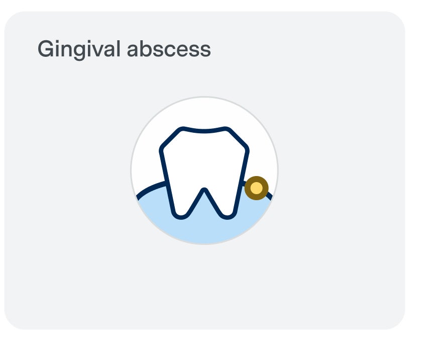  Illustration of a gingival abscess showing a tooth with a highlighted gum area and a yellow spot indicating infection.
