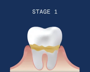 Receding gums stage 1 - Early periodontitis: slight gum recession begins. Early bone loss and small pockets form below the gum line.