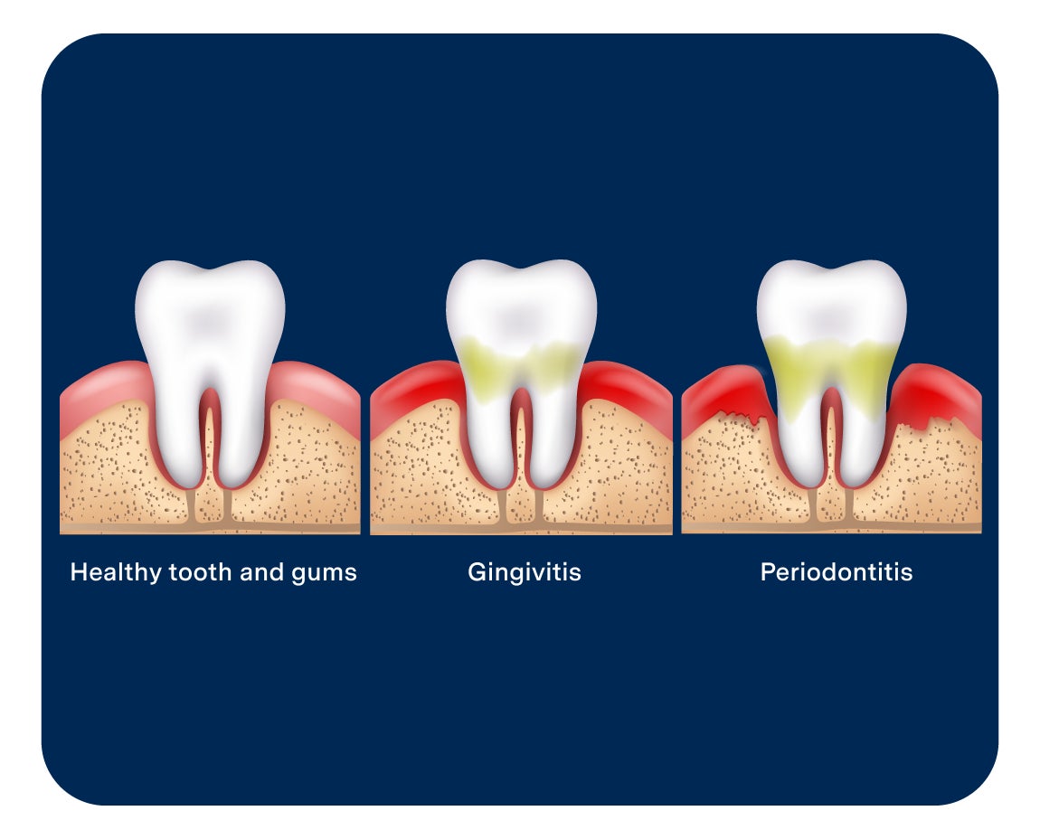 Diagram comparing healthy gums, gingivitis, and periodontitis, showing progression from healthy teeth to inflamed gums and bone loss for Aspen Dental.