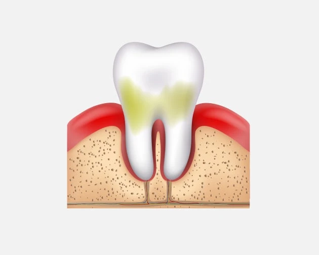 an image of tooth and gums infected with early stage of periodontitis.