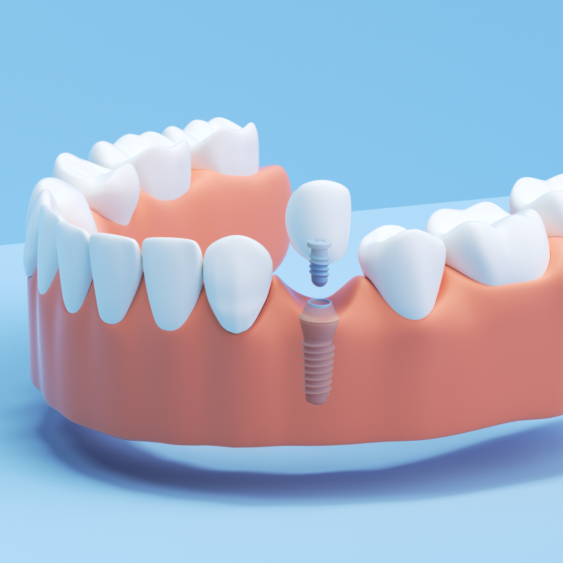 Aspen Dental Single Tooth Implant