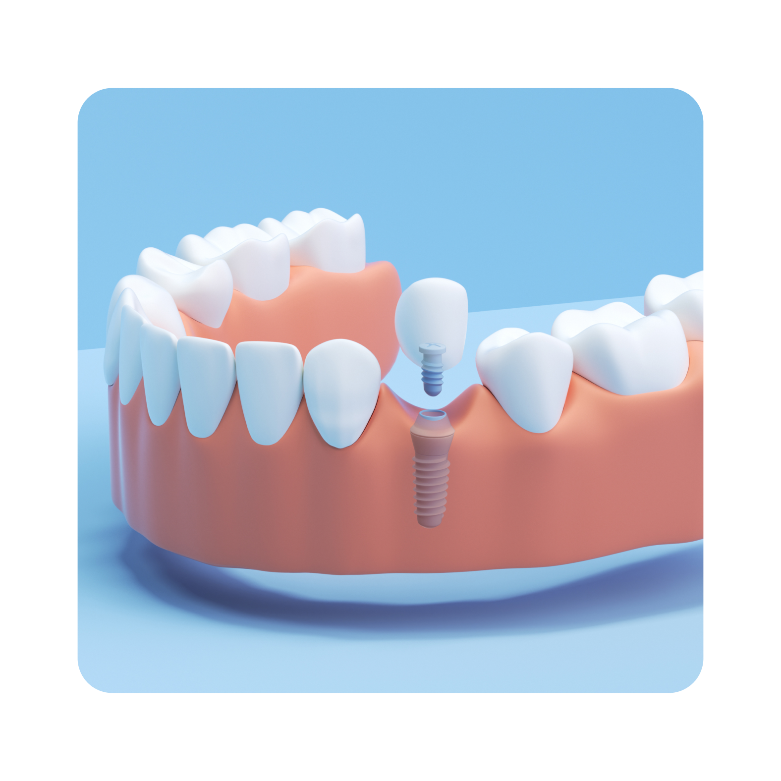 Aspen Dental Single Tooth Implant