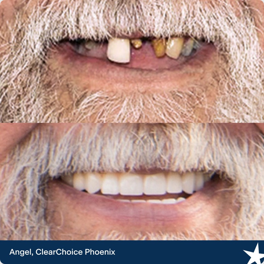 The before and after dental implant images of Angel. Our ClearChoice patient from Phoenix.
