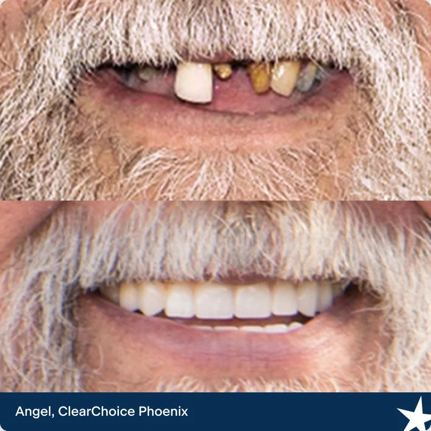 The before and after dental implant images of Angel. Our ClearChoice patient from Phoenix.