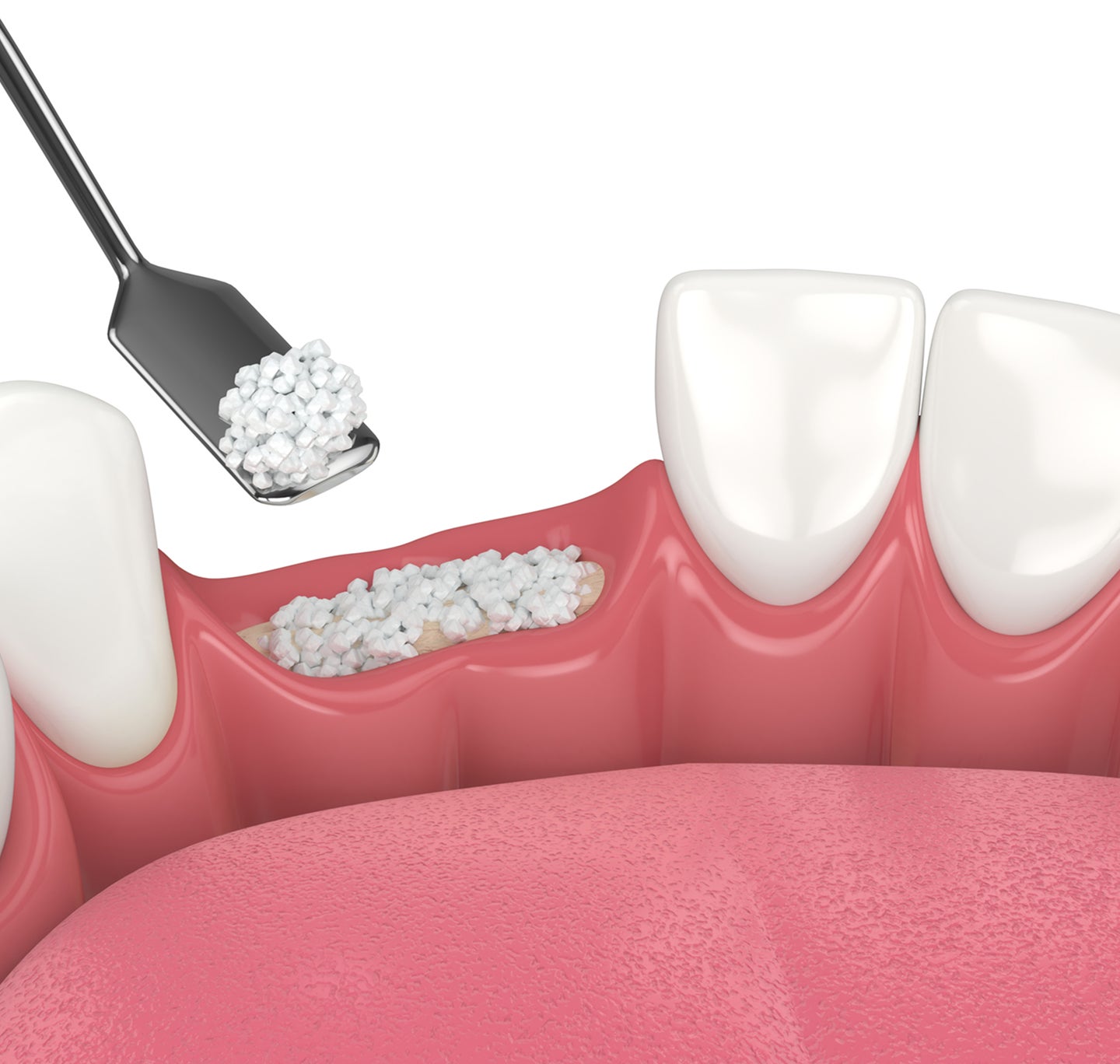 3D illustration of a bone grafting procedure in dentistry, where granulated bone material is being placed into an area of jawbone loss. This procedure helps regenerate bone structure for future dental implants. Aspen Dental provides expert bone grafting solutions for restoring oral health.