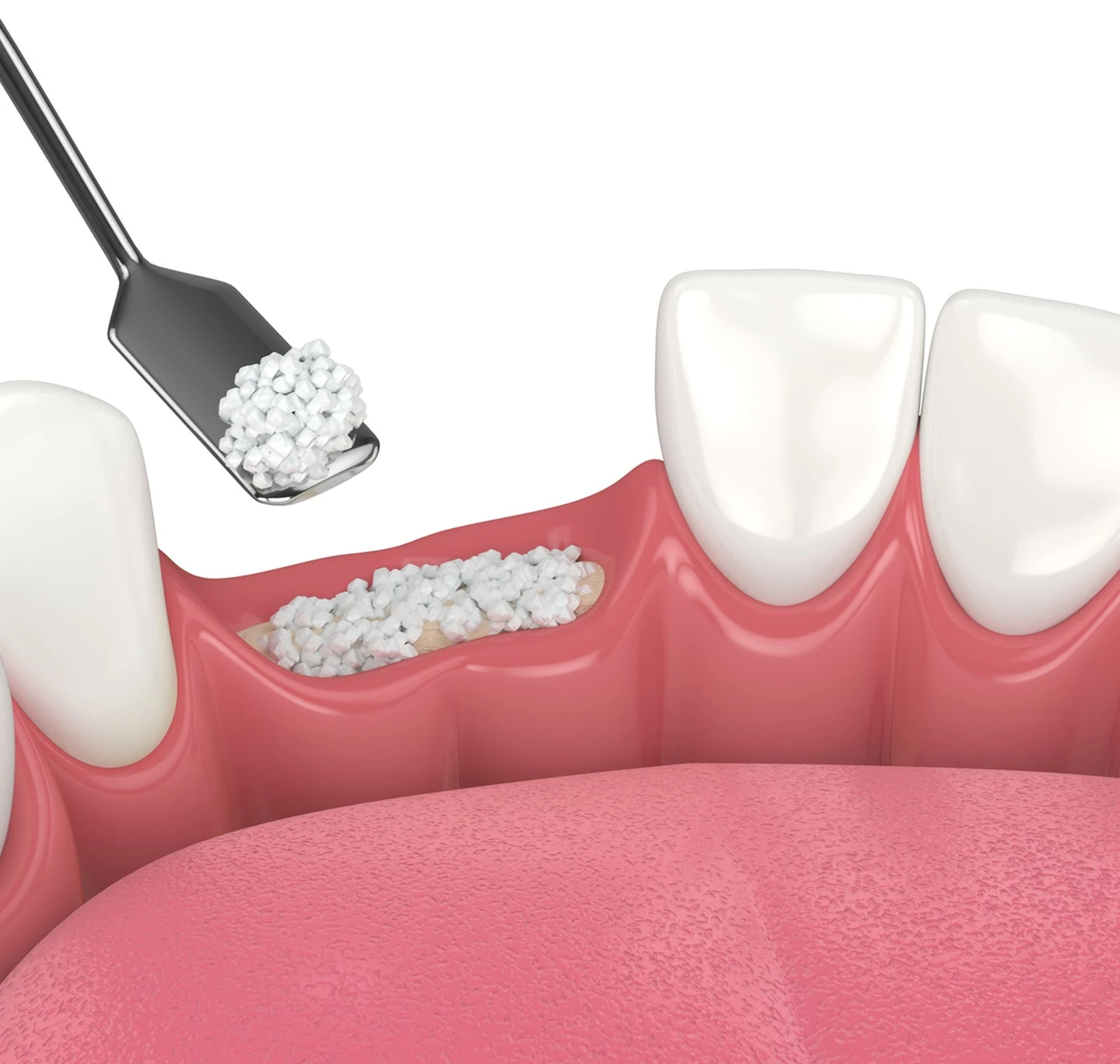 3D illustration of a bone grafting procedure in dentistry, where granulated bone material is being placed into an area of jawbone loss. This procedure helps regenerate bone structure for future dental implants. Aspen Dental provides expert bone grafting solutions for restoring oral health.