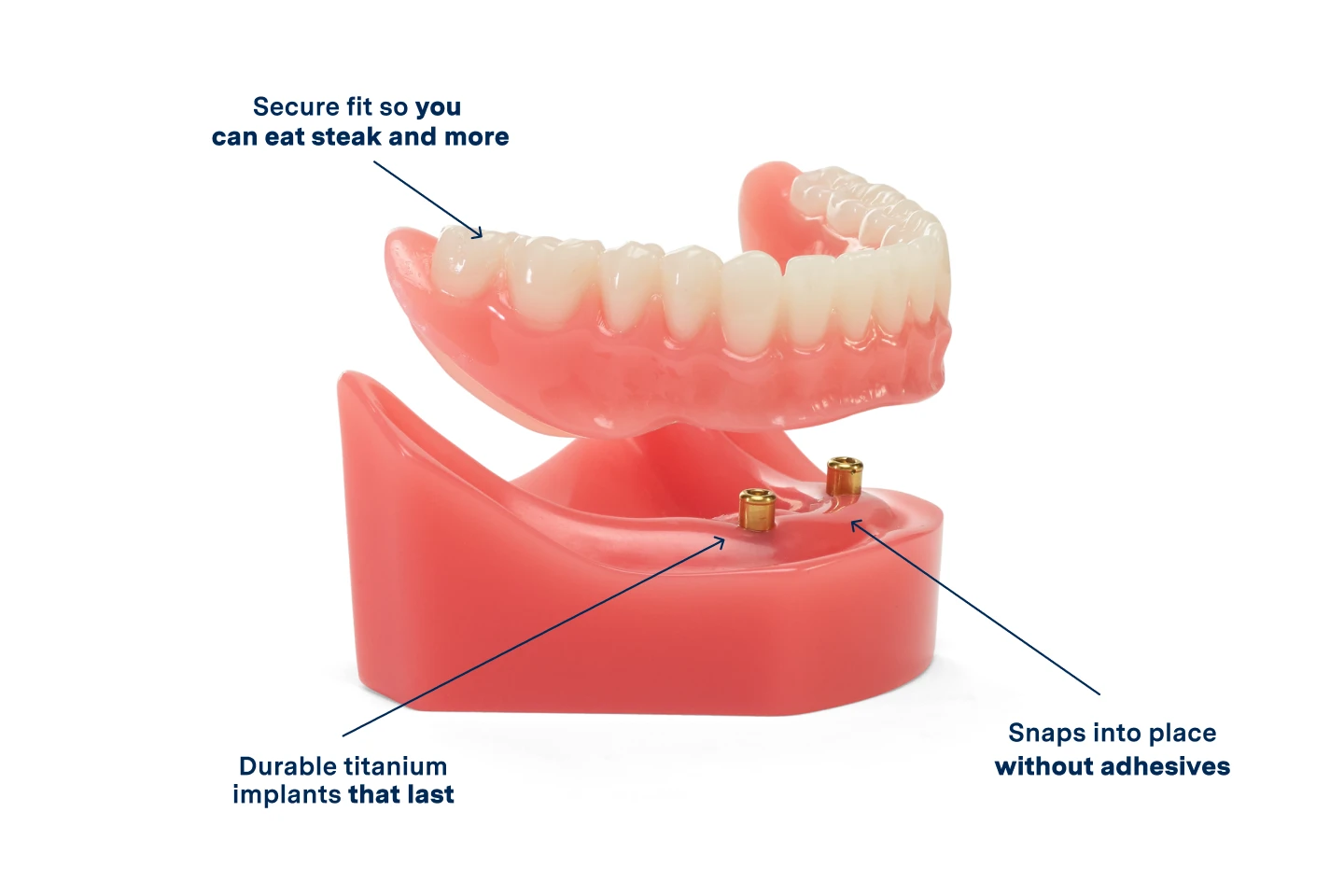 A model of implant dentures showcasing the features:
3x stronger bite than conventional dentures
snaps into place without adhesives, and
A lasting titanium implant for a comfortable fit