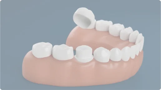 A 3D rendering of the placement of a dental crown. 