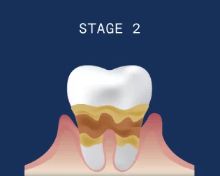 Receding gums stage 2 - Moderate periodontitis: Increased gum recession. with noticeable bone loss and deeper pockets. Damage is caused to the supporting bone structure.