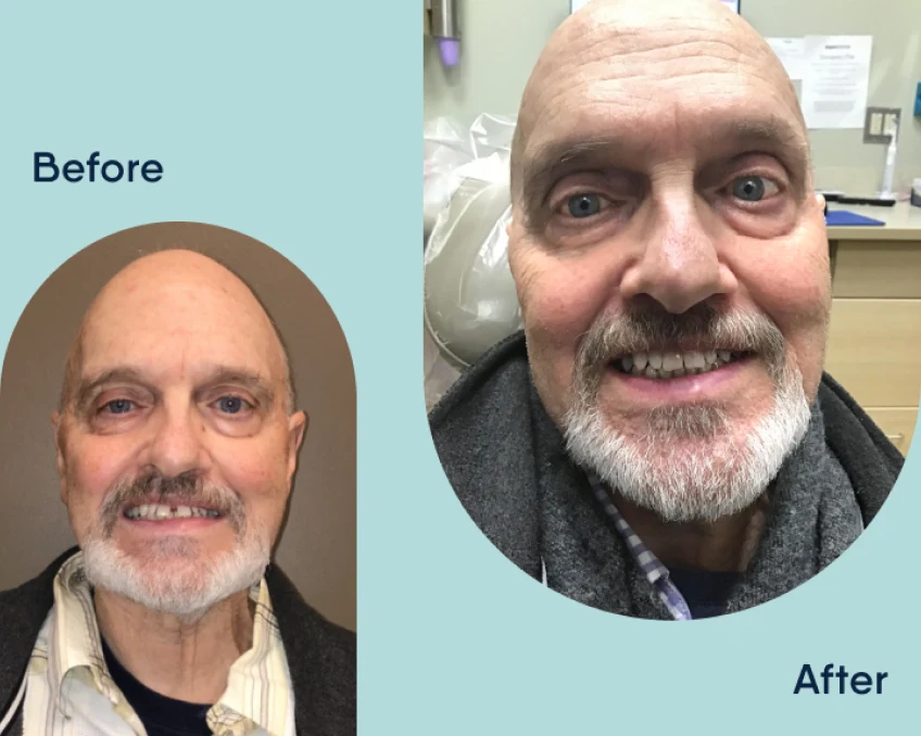 Before and after comparison photos of a senior man's smile transformation with Motto.