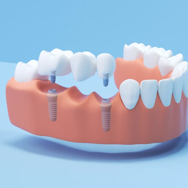A 3D image of an Aspen Dental implant-supported bridge. 