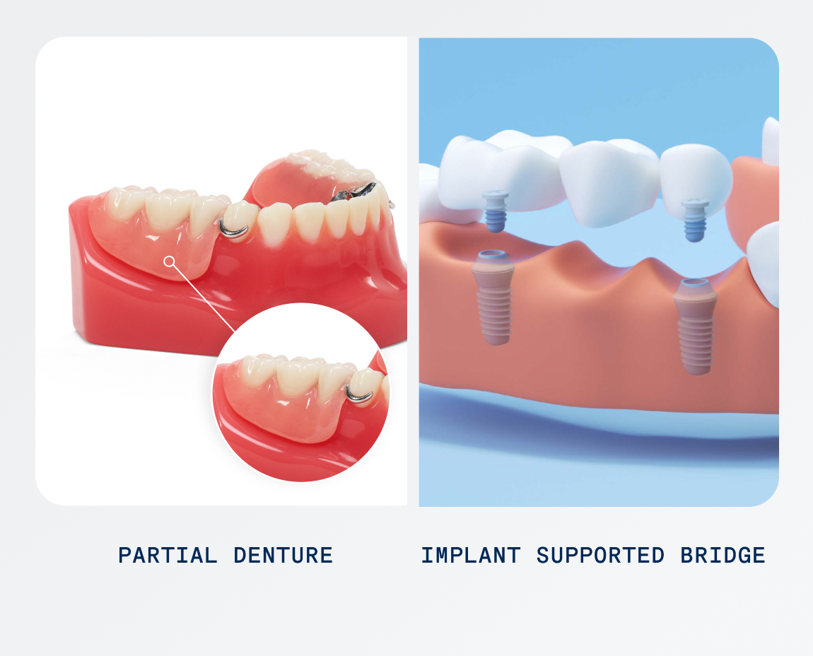 A comparison between different tooth replacement solutions. Left image shows a partial denture on a gum model. Right image shows an implant-supported bridge on a gum model with two dental implants. Labels below: "Partial Denture" and "Implant Supported Bridge.