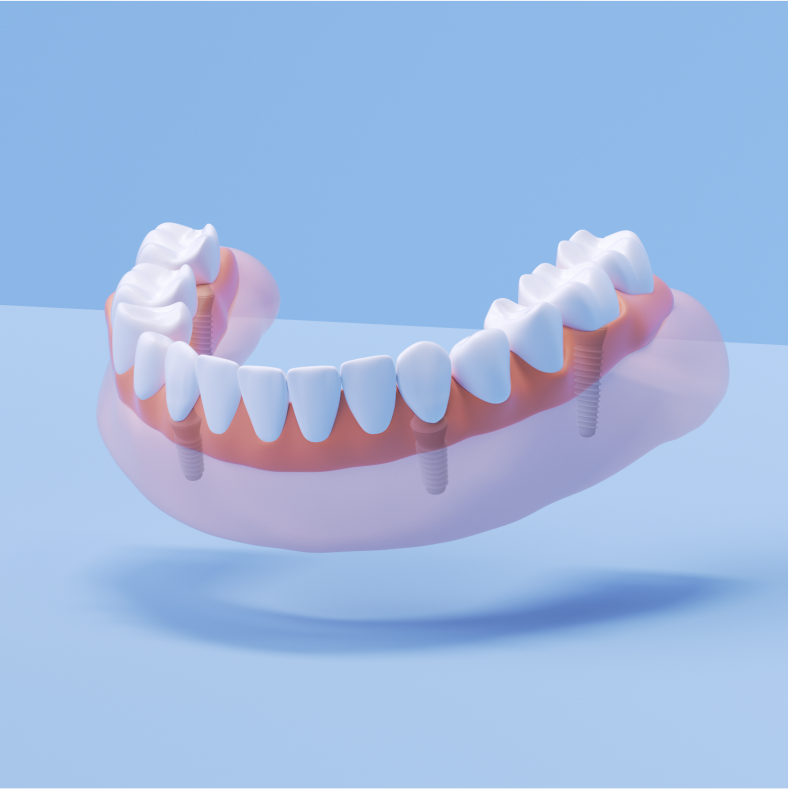 Aspen Dental implant dentures. 