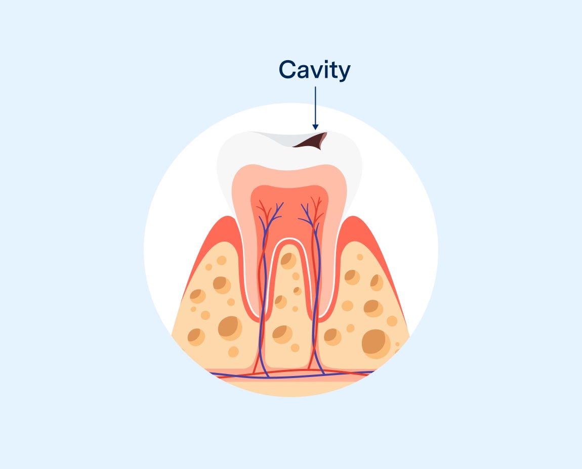  Illustration of a tooth with a cavity, showing internal structure including enamel, dentin, and nerve pathways. The cavity is labeled at the top, indicating decay on the tooth surface.