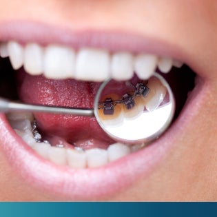 Application of lingual braces placed behind the teeth, providing a virtually invisible orthodontic solution.