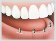 Aspen Dentures Implant Support