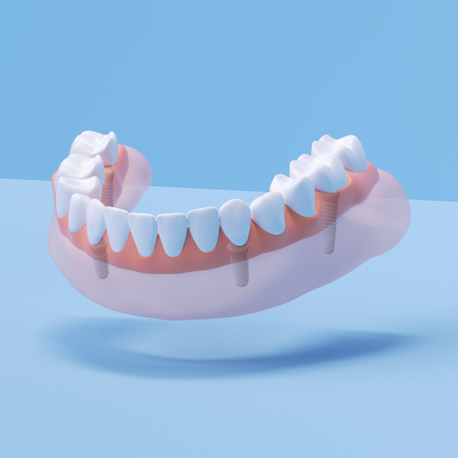 3D illustration of a lower dental implant model showing artificial teeth anchored to the gums, floating on a light blue background.