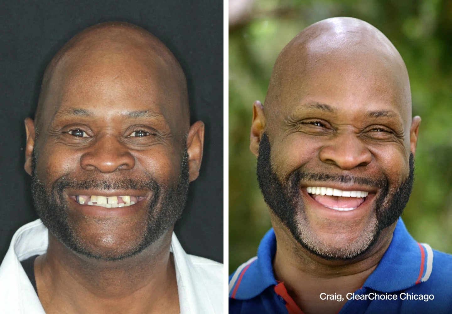 Before and after dental implant pictures of our Chicago ClearChoice patient, Craig.