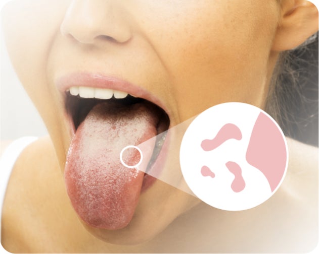 A person with their mouth open shows their tongue with a white coating, suggesting oral thrush. An inset magnifies the coating, providing a closer view of the infection.