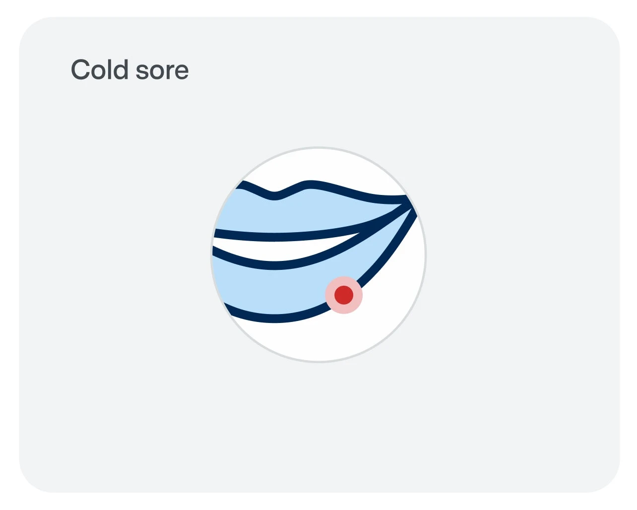 Illustration showing lips in blue color with a red dot outside the mouth representing a cold sore. The text "Cold sore" appears in the top left corner.