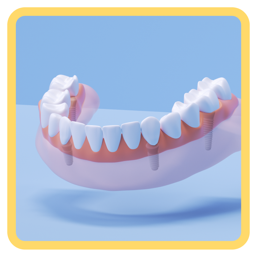 Un gráfico que muestra un implante de arco fijo completo sobre un fondo azul claro.