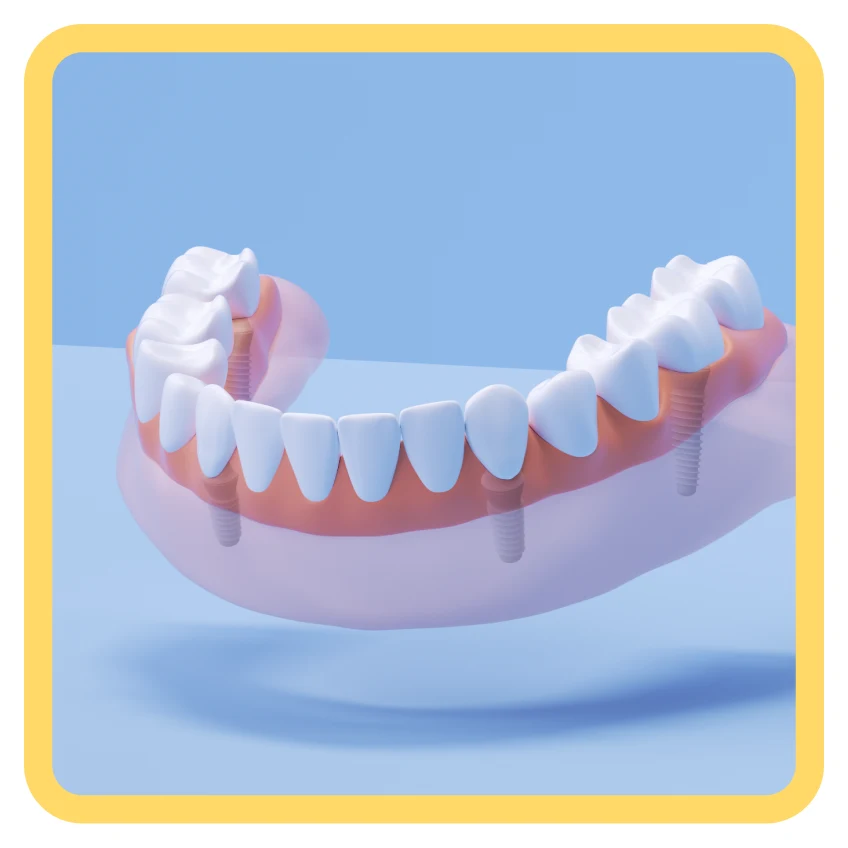 Un gráfico que muestra un implante de arco fijo completo sobre un fondo azul claro.