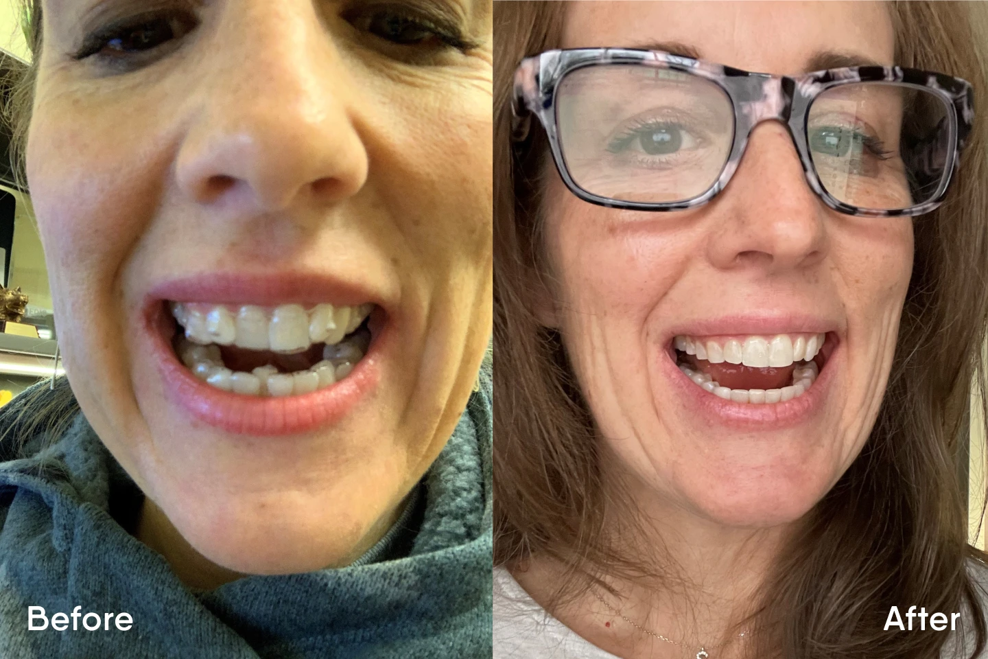A before and after image showcasing the effects of Motto clear aligners. 