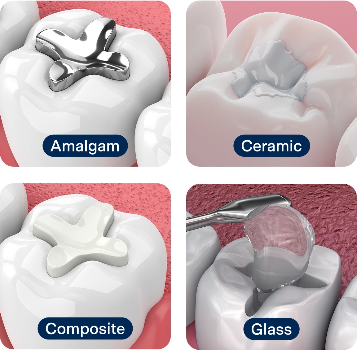Close-up renderings of four types of dental fillings—amalgam, ceramic, composite, and glass—each shown applied to molars with clear material labels.
