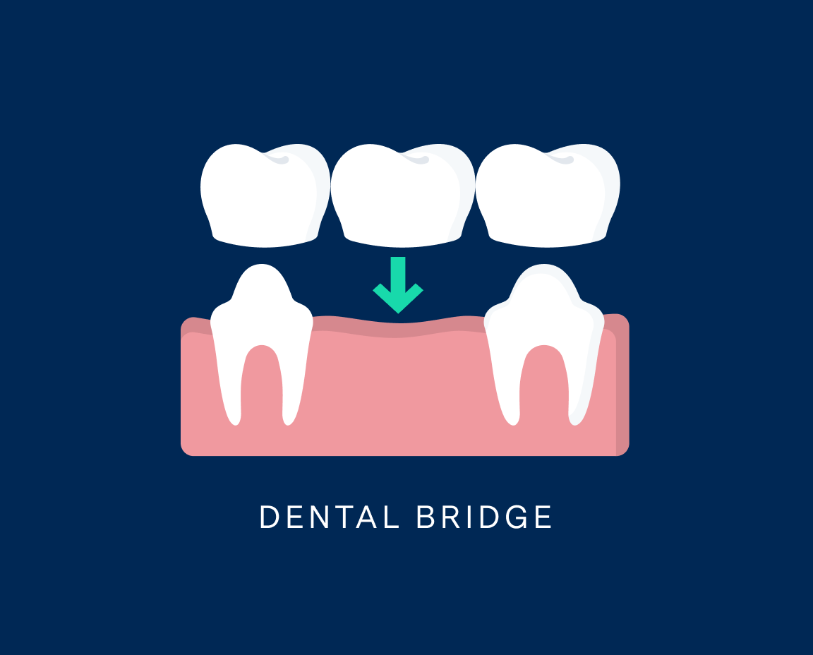 Illustration depicting a dental bridge with three teeth crowns suspended above a set of treated teeth, showing a missing tooth with an arrow pointing downwards, indicating the position where the bridge will be placed, against a dark blue background. Text at the bottom reads "DENTAL BRIDGE".