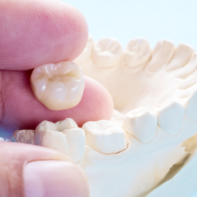 Root Canal Crown Cost