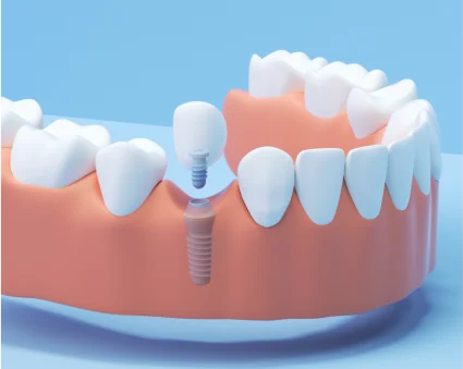 An illustration of a single tooth dental implant showcasing a tooth and an implant as a permanent solution for missing teeth.
